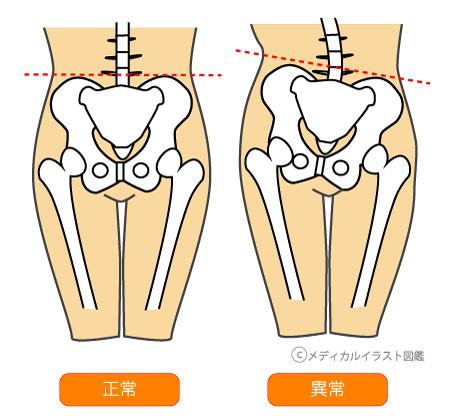 ãè°æ¤ã®æ­ªã¿ãã®ç»åæ¤ç´¢çµæ