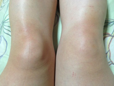 膝の腫れ.jpg