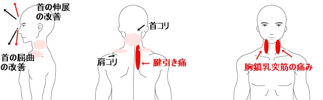 首のこり 痛み 寝違い 亀岡市の整体は肩こりや腰痛の改善実績が豊富な有楽健康整体院