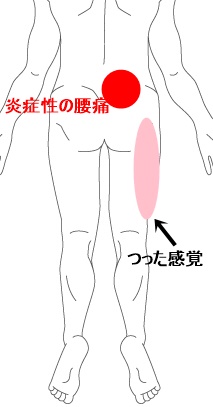 症例イラスト3.jpg