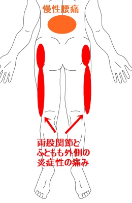 左 太もも 痛い