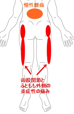 外側 痛い 太もも 太ももの外側に痛みやシビレが出る原因と治療法