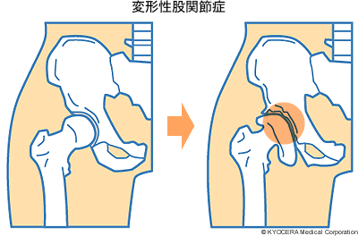 変形性股関節症 手術の回避でお悩みの方へ 亀岡市の整体は肩こりや腰痛の改善実績が豊富な有楽健康整体院