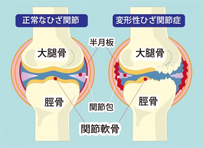 ひざ 膝 痛 症状の根本的な改善方法 亀岡市の整体は肩こりや腰痛の改善実績が豊富な有楽健康整体院