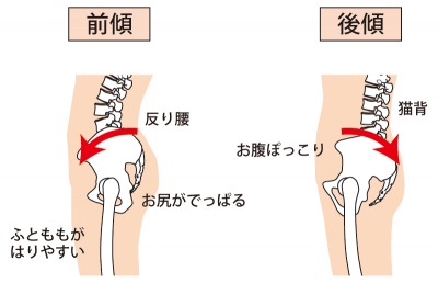 骨盤後傾・前傾.jpg